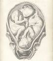 Twins - Twins in the Embryo.