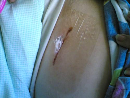a 52 thousand pesos stitch - my mother's operated tummy..