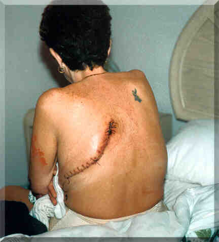 Picture of Operation - This is a picture of a lung cancer victim.