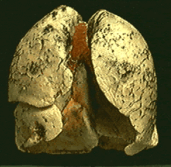 Lung Cancer - This is what a lung with cancer looks like.