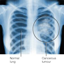 An xray of lung with cancer - This is how it looks like.
