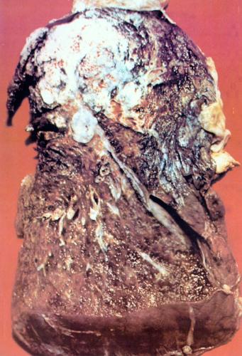 Dirty Lungs - This is gross.