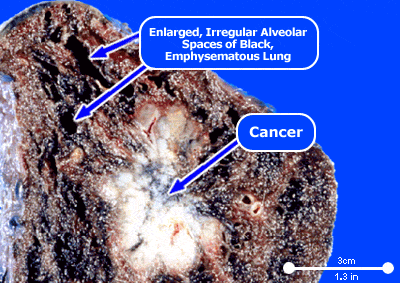 Lung Cancer - Imagine you lungs.