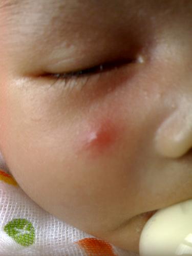 pimple or bug bite ! - being bite by a mosquito. what a big pimple he has ;)
