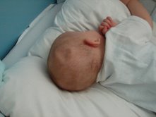 Baby's head after fall - Bump on a baby's head after hitting some furniture corner.