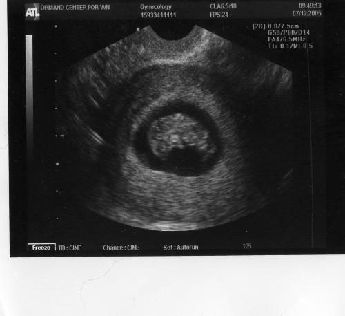 Fetus at 9 weeks  - Fetus at 9 weeks gestation.