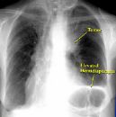 lung cancer - x-ray of cancered lungs