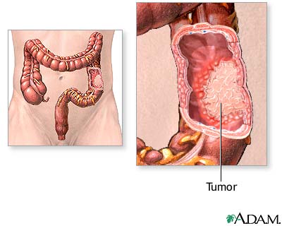 colon cancer - colon cancer is cancer in the intestines, you can see in the photo that the cancerous tumor is in the large intestine...