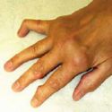 Arthritic hands - hands