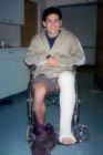 leg - broken leg - broken