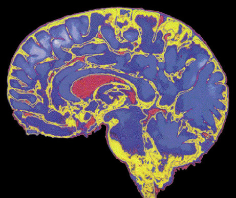 brain - brain tumour tumor, brain images.