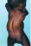 scoliosis - abnormalities in the bone structure