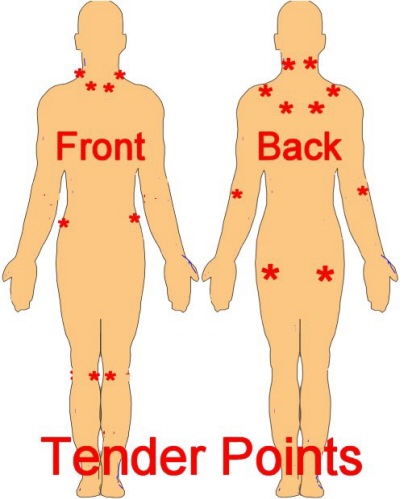 Fibromyalgia - The main pressure points of Fibromyalgia pain are shown here.