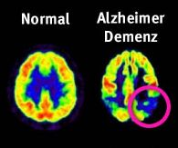 alzheimer - this is alzheimer disease