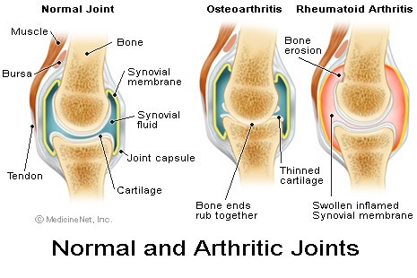 rheumatoid arthritis - a disease one should take care of...