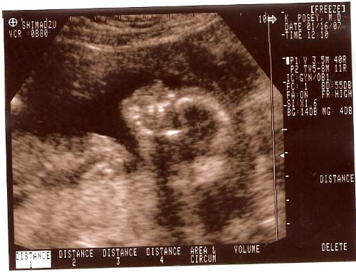 ultrasound - babys face