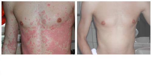 before / after - This pictures are showing me suffering severely from p for a good 32 yrs and after using for two weeks a remedy from Thailand that is according to the suppliers made from a 100% natural / herbal ingredients