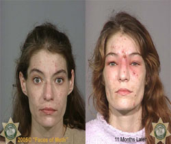 The face of meth - picture of before and after affects of meth