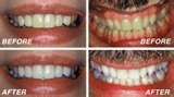 effective whitening - what would you suggest for whitening teeth?