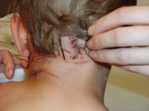 Cody back of head! - After dog attack this is the back of codys head where he recieved 20 staples.