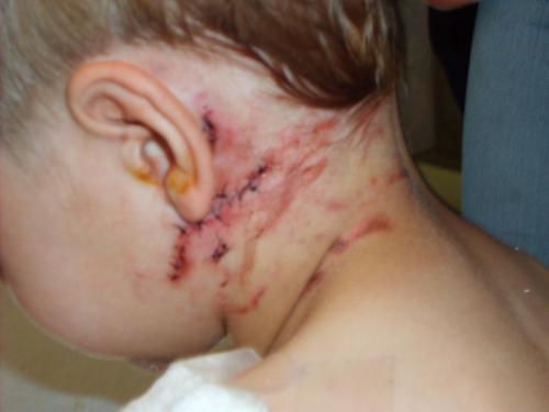 Codys dog attack - Cody attacked by dogs on April 7th 2007!