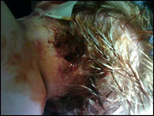 My sons head right after attack by 7 Vicious Dogs! - My son was attacked by 7 dogs on Saturday April 7th 2007.