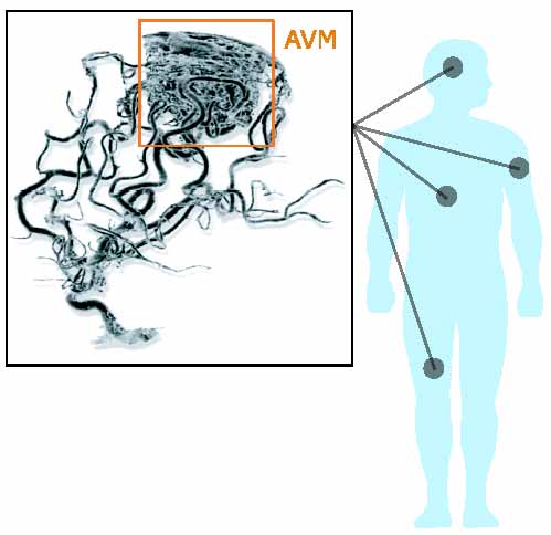 arterio venous malformations what are they? - AVMS explained