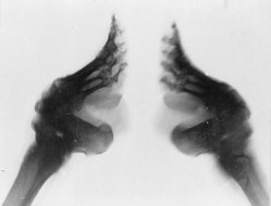 Lotus feet - ex-rays of lotus bound feet.