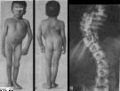 scoliosis - Scoliosis, curvature of the spine