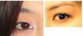 eyelid change - change single eyelid into double eyelid