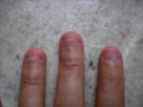 My short fingernails - Here is a picture of my ridiculously short fingernails.