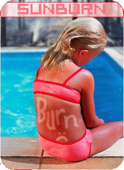 Sunburn - Don't burn your skin ever :(