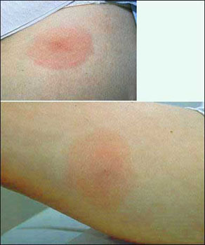 Rocky Mountain spotted fever Symptom  - Typical symptoms include fever, headache, fatigue, and a characteristic skin rash