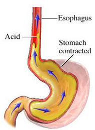 Acid Reflux - A diagram of what the stomach looks like when acid reflux happens.