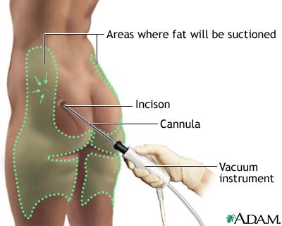 liposuction procedure - Do you agree with this?
