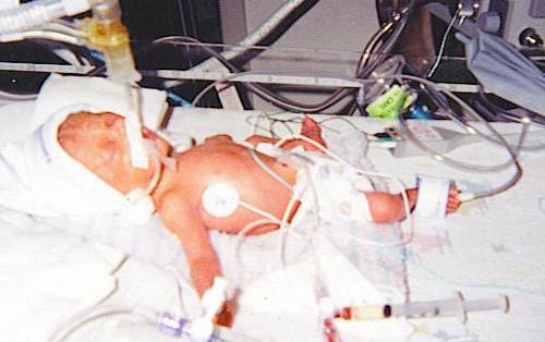 Premature infant - My nephew was born 11 weeks early. He weighed 2 pounds 1 1/2 ounce.