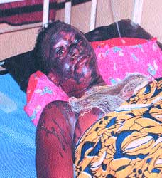 Bath With Raw (Undiluted) Acid ! - have you seen somebodythat is bath with acid? it is always a sorry sight. it gives me concern especially if the person has no money for surgical operation.