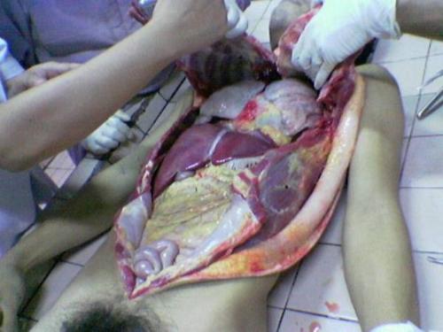 Cut My Life Into Pieces - This my last resort,Suffocation no bleeding