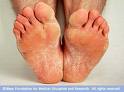 Athlete Foot - How do you handle your Athlete Foot?