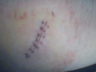 my stitches - Please ecuse the poor quality as my webcam is just plain crap