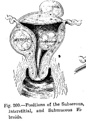 Uterine Fibroids - Depiction of a fiboid growing inside the uterus. 
