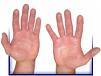 sweaty hands - hands sweating