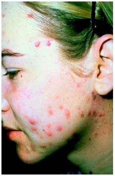 acne on the face - acne on the face a big hindrance 