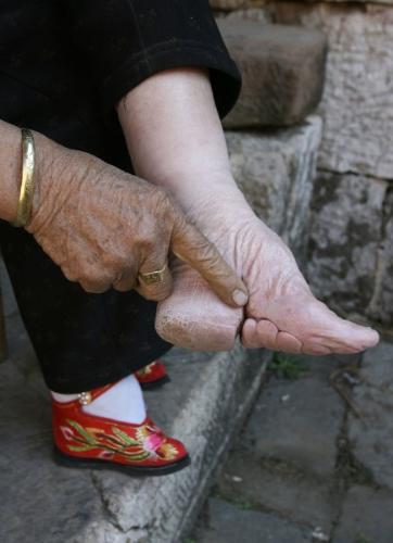 Foot Binding - This is a pic of a woman's foot after binding her feet..and compare it to the other..they are the size of a cigarette box!