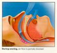 Snoring - Snoring is a condition. Not just a social problem.