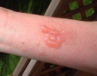 boil on my leg - the boil started with an itch