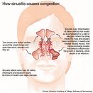 sinusitis - this photo is from www.onlineallergycenter.com