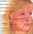 sinusitis - this is from www.everybody.co.nz