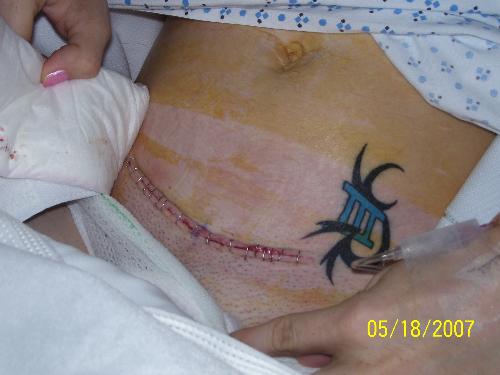 My hysterectomy incision - had a hysterectomy...