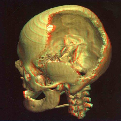 Human Skull - This is a picture of damaged human skull